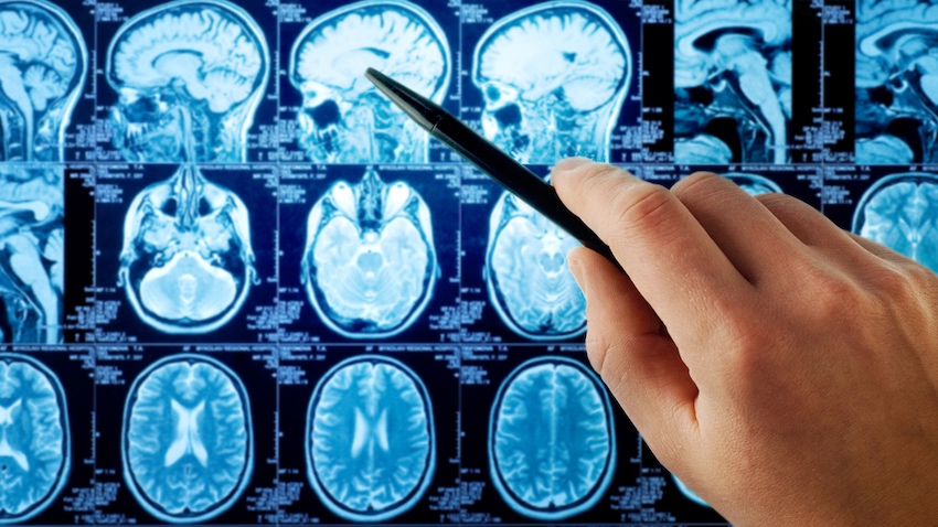 蔡俊明專欄 | 每 3 ~ 4 位肺癌病人就有一個腦轉移，如何及早偵測？