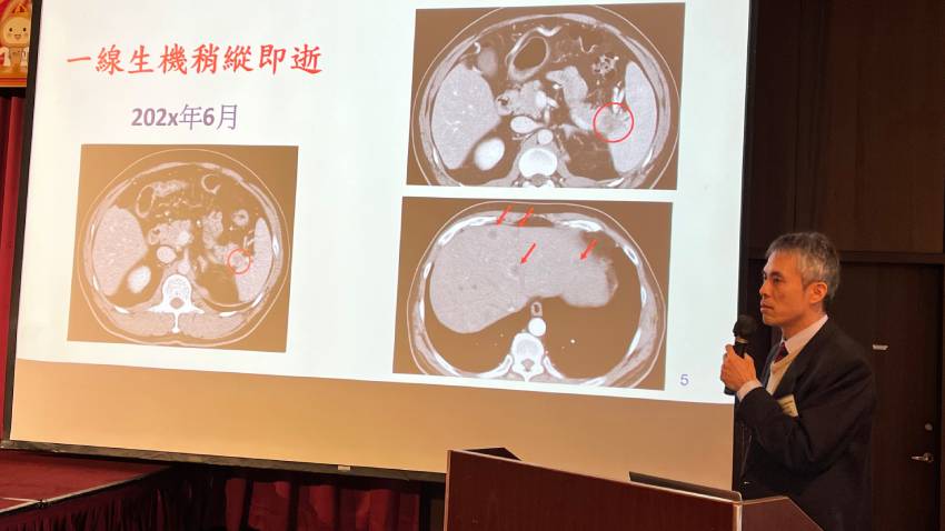 4 成早期胰臟癌在CT檢測難發現！台大首創AI輔助，9 成正確率、1 分鐘揪微小病灶