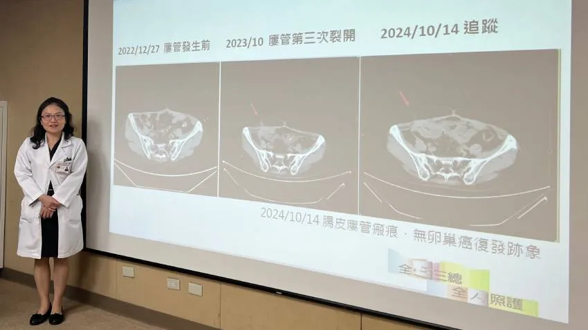 中西醫聯手，卵巢癌患者擺脫腸道反覆破損瘻管之苦，恢復正常生活