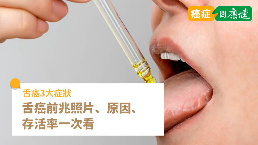 舌癌3大症狀，舌癌前兆照片、原因、存活率一次看