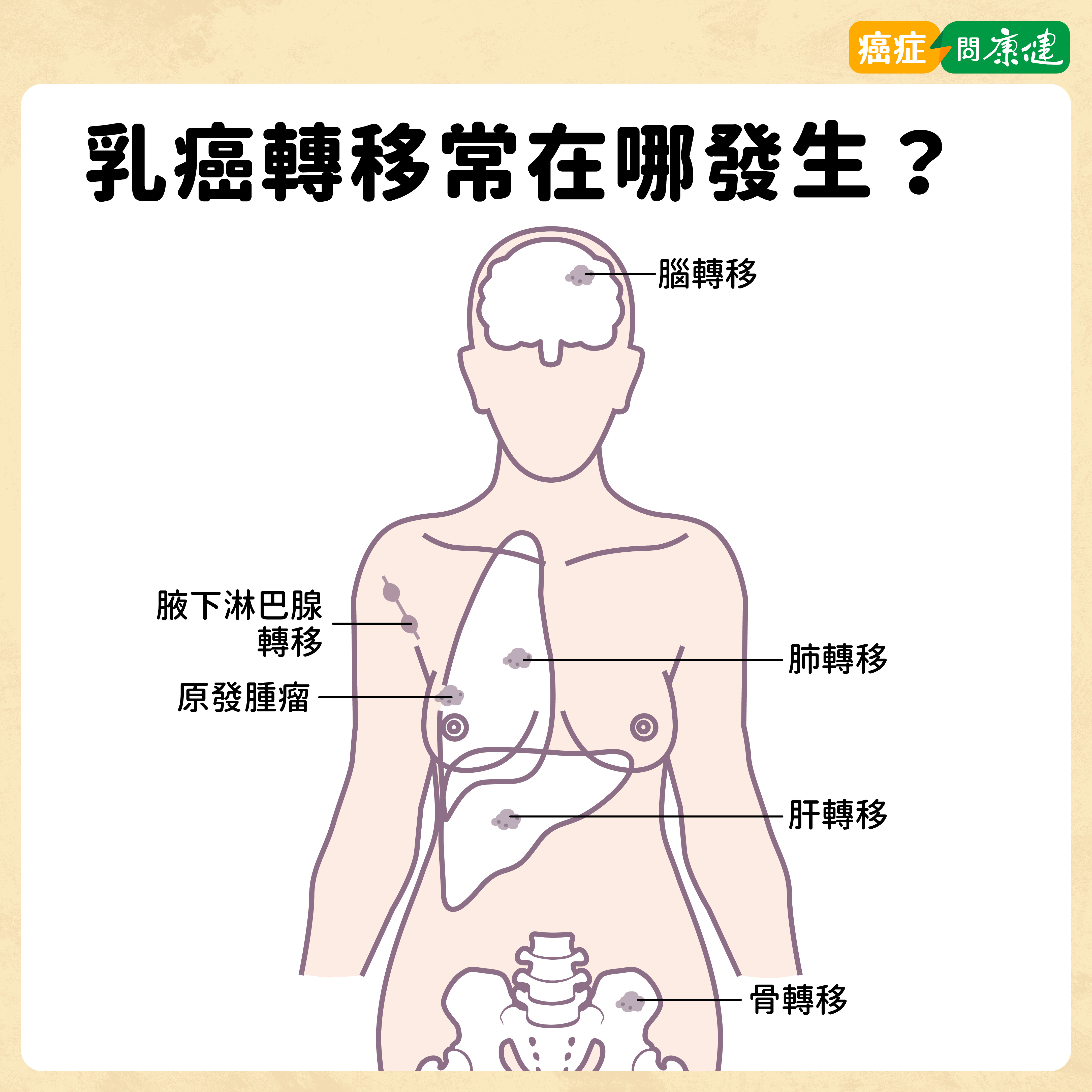 乳癌轉移常在哪發生？