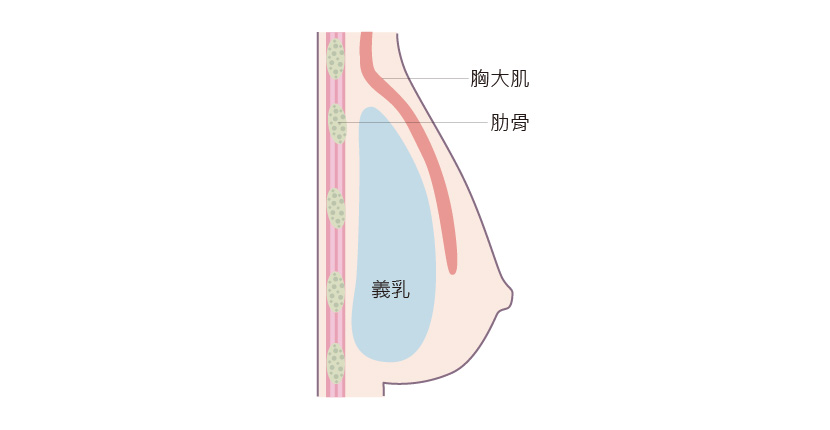 義乳植入