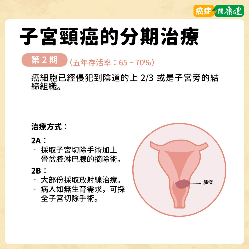 子宮頸癌第2期治療方法與存活率