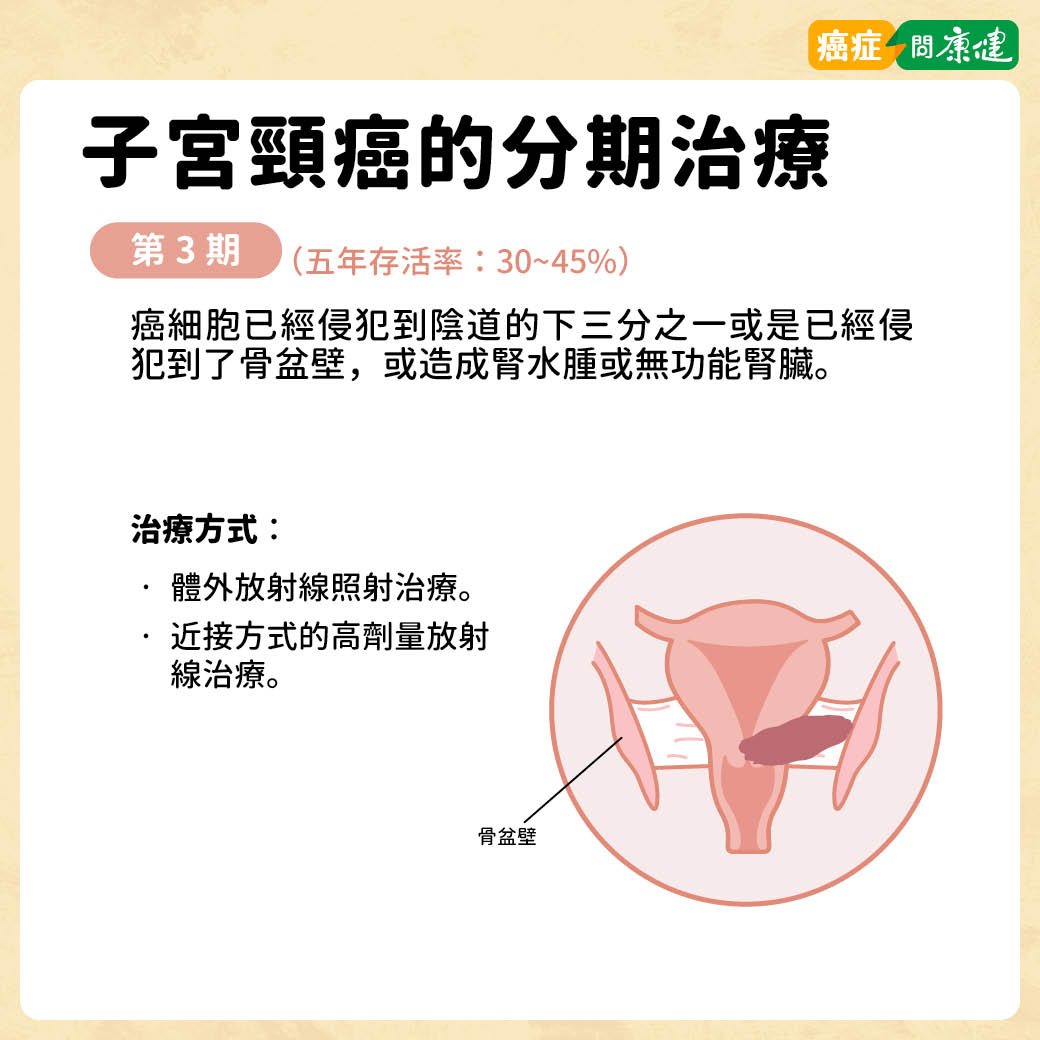子宮頸癌第3期治療方法與存活率