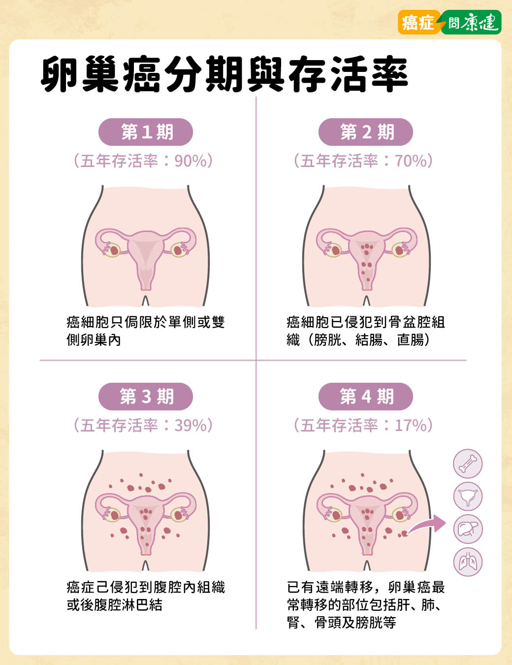 卵巢癌如何分期？卵巢癌各期存活率、卵巢癌治療方式一次了解