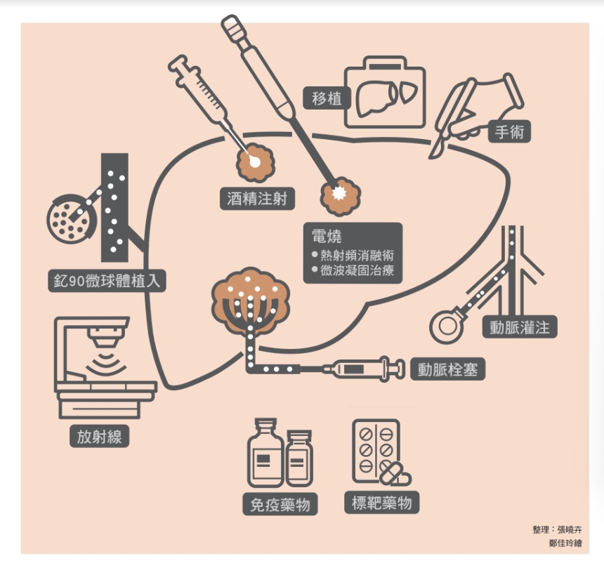 肝癌治療方式