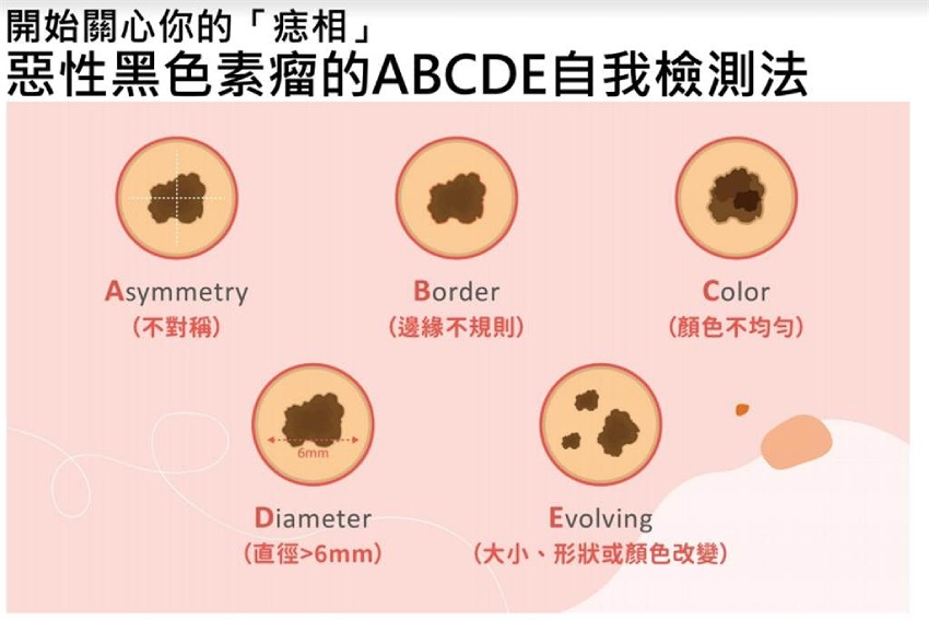 長痣是皮膚癌前兆？惡性黑色素瘤自我檢測法