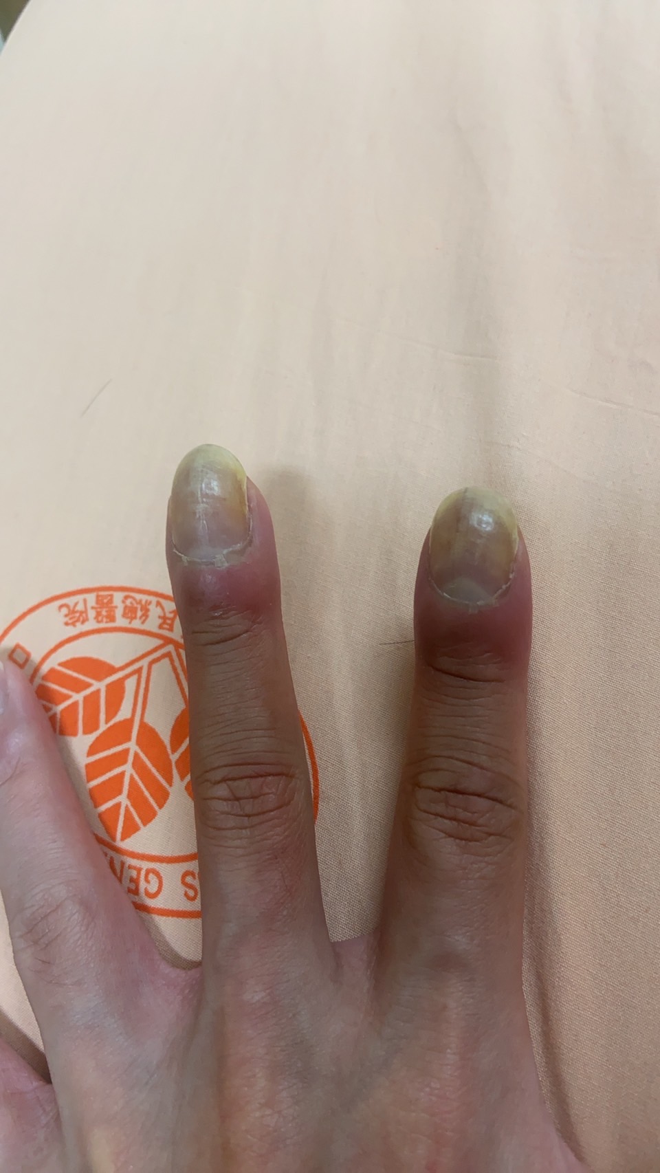 杵狀指照片