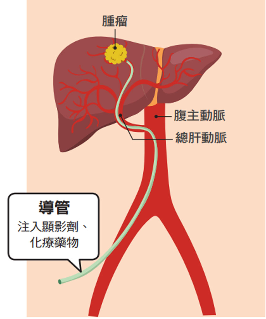 肝動脈栓塞治療