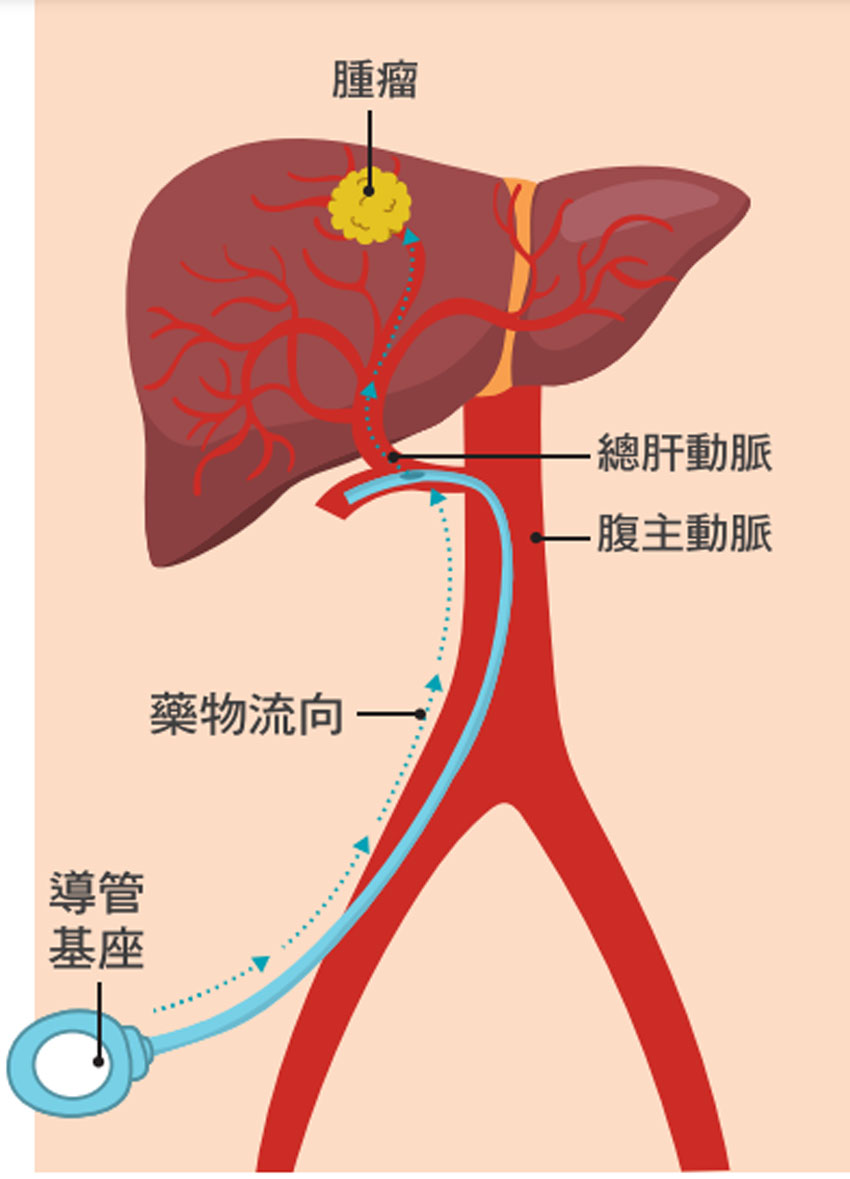 經肝動脈灌注化學治療