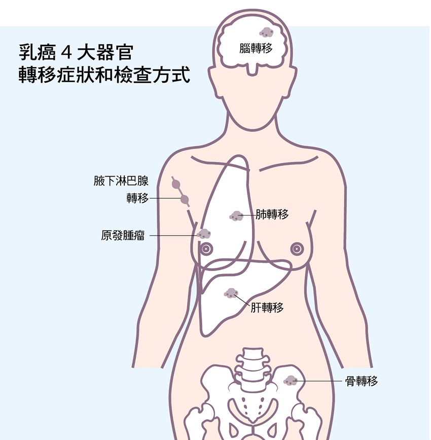 乳癌復發有哪些前兆？乳癌4大器官轉移症狀和檢查方式