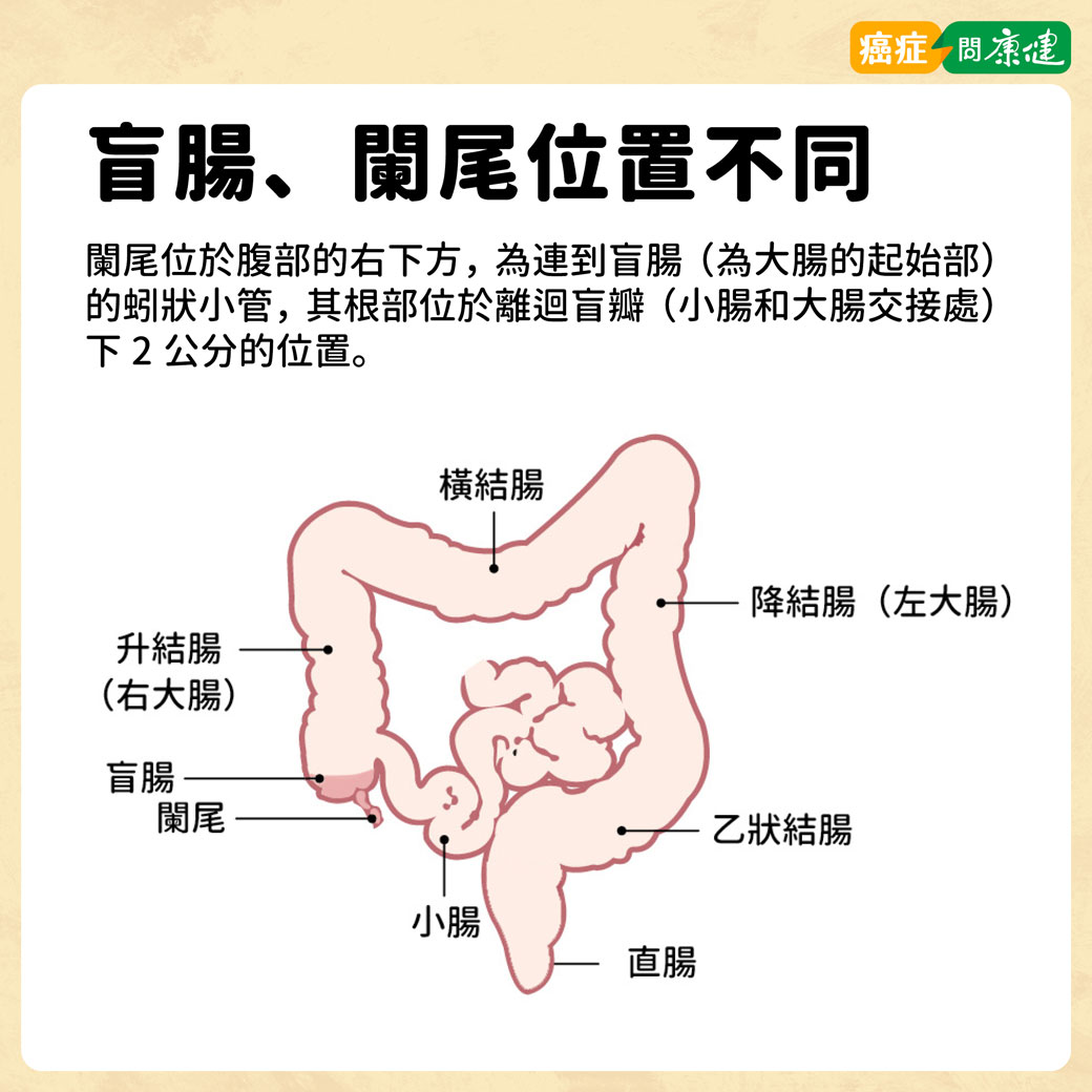 盲腸、闌尾位置不同